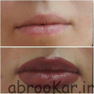 میکروپیگمنتیشن لب شمال تهران