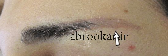 میکروپیگمنتیشن ابرو