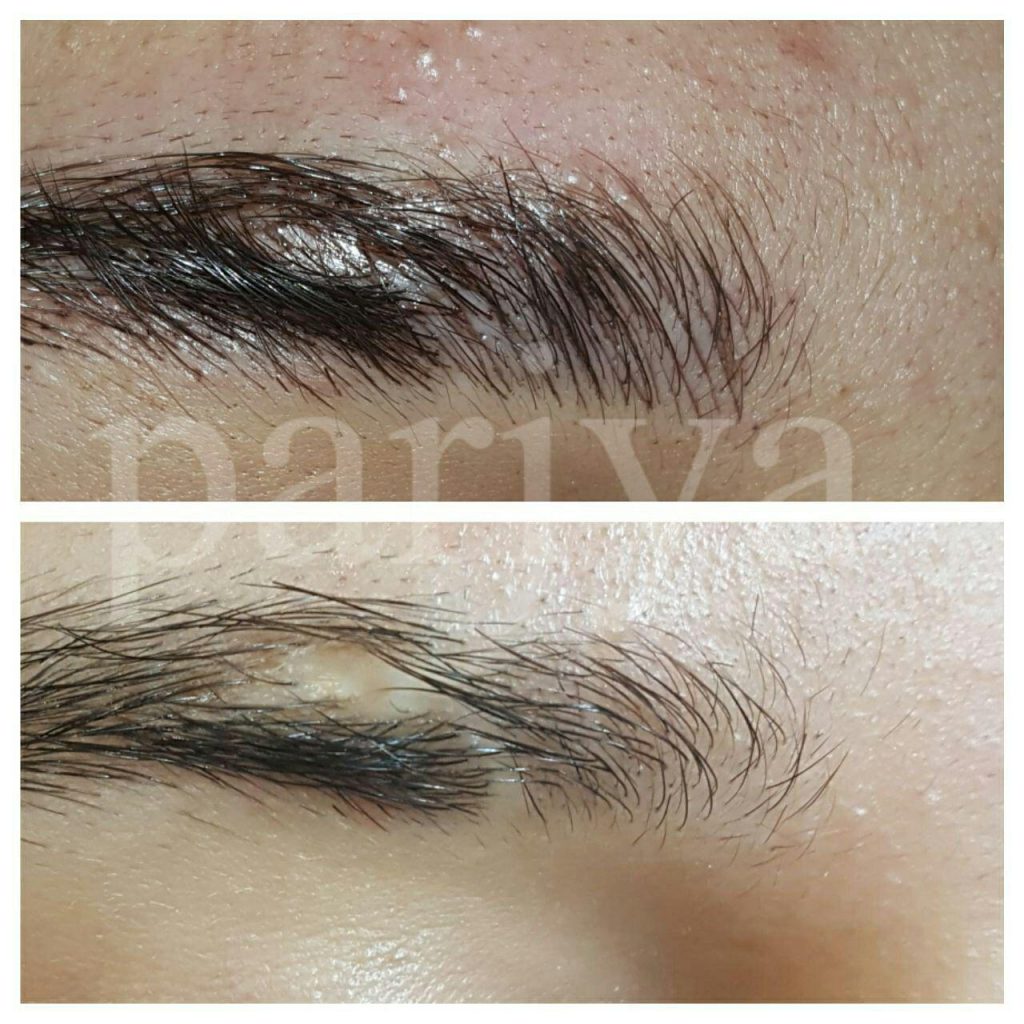 گروه میکروپیگمنتیشن ، میکروپیگمنتیشن تخصصی